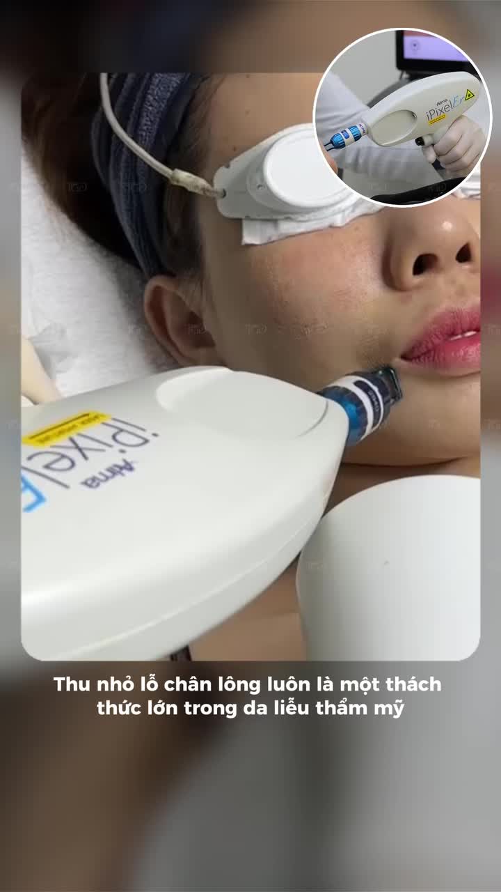 Thu nhỏ lỗ chân lông luôn là một thách thức lớn trong da liễu thẩm mỹ nếu chỉ áp dụng các phương pháp bôi thoa trên bề mặt.