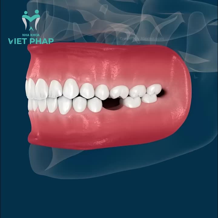 CHỈ MẤT 1 RĂNG THÌ CÓ SAO KHÔNG?
