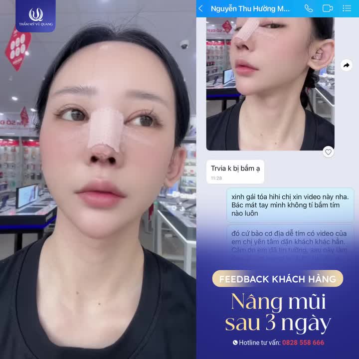 Nâng mũi 3 ngày - Không sưng, không bầm, đẹp tự nhiên!