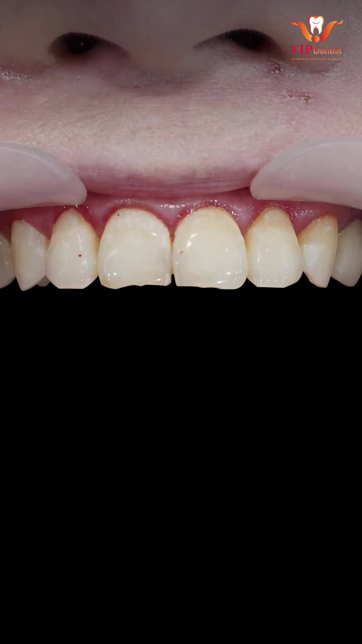 SIÊU PHẨM TRONG - BÓNG - LẤP LÁNH!