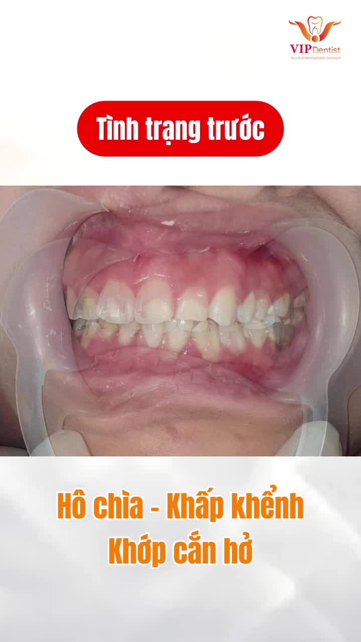 CẢI THIỆN HÔ CHÌA - KHẮC PHỤC KHỚP CẮN