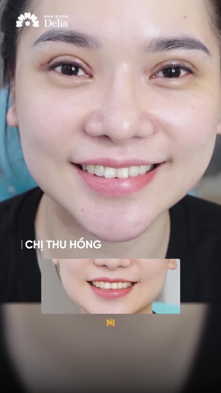 RĂNG Ố VÀNG tẩy trắng nhiều lần không hết