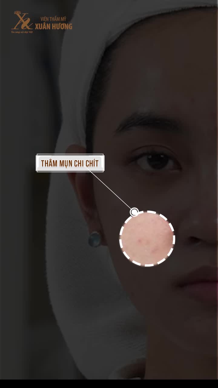 BỊ MỤN TÁI ĐI TÁI LẠI DÙ ĐÃ THỬ NHIỀU PHƯƠNG PHÁP?