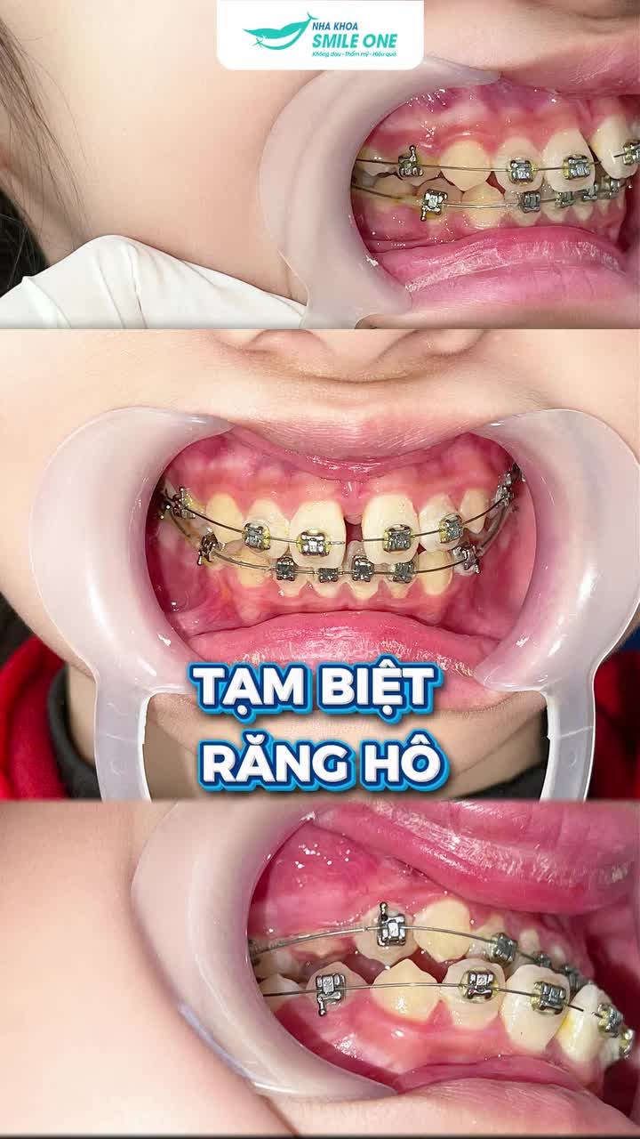 NIỀNG RĂNG SỚM – CON TỰ TIN HƠN VỚI NỤ CƯỜI MỚI!