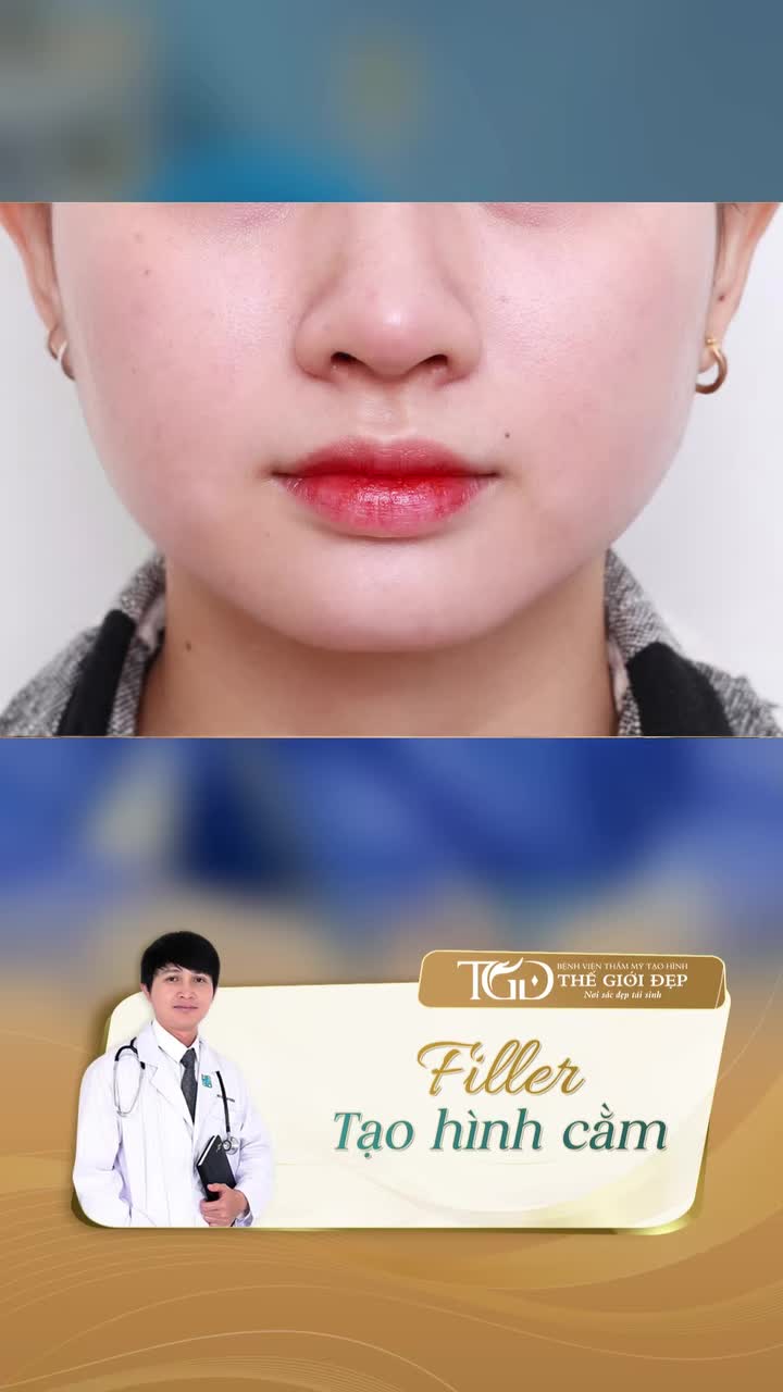 FILLER TẠO CẰM V.LINE CHỈ VỚI 2CC  Thay đổi nhẹ nhàng – Thần thái nâng tầm rõ rệt