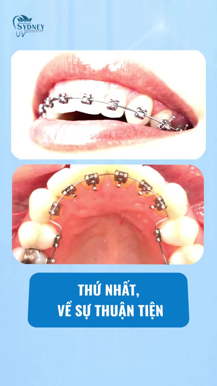 NÊN NIỀNG RĂNG MẮC CÀI MẶT NGOÀI HAY MẮC CÀI MẶT TRONG?