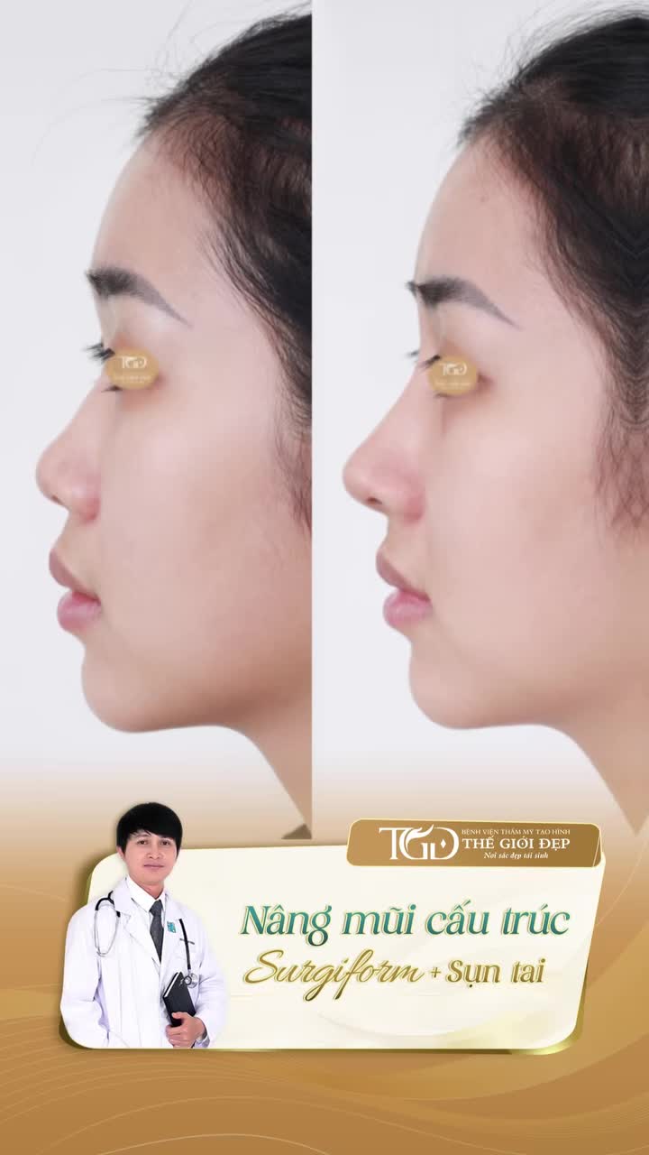 Lấy sụn tai trong nâng mũi liệu có ảnh hưởng đến hình dáng tai?