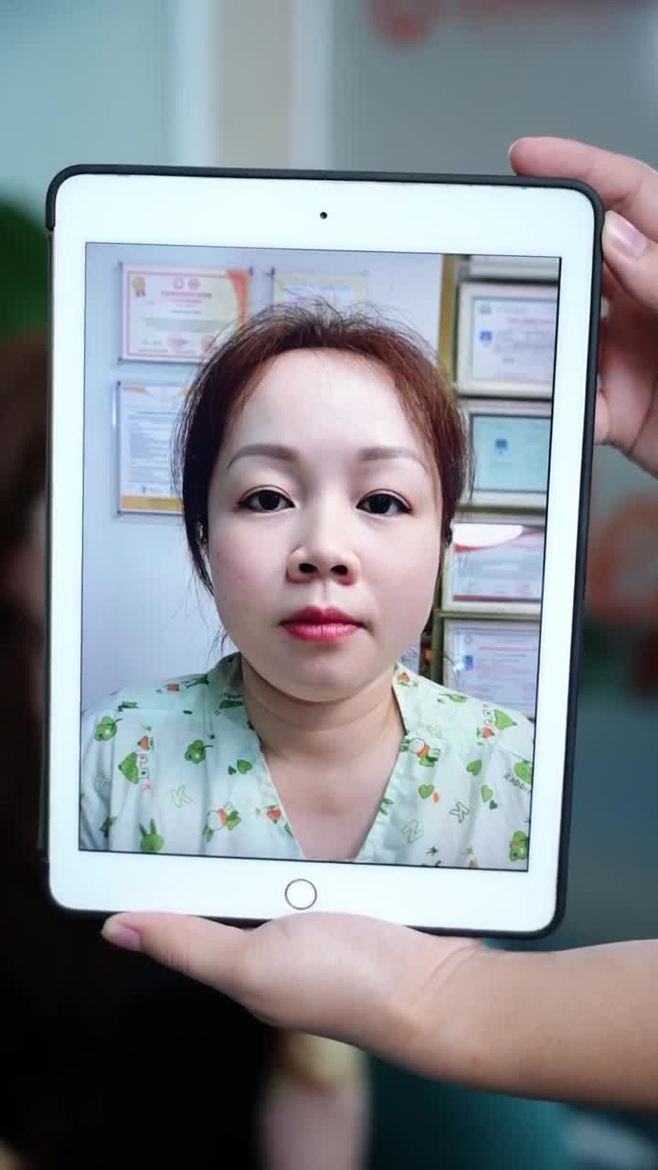 TÁI KHÁM SAU 10 NGÀY THỰC HIỆN COMBO NÂNG MŨI + CẮT MÍ