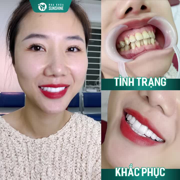 "TRƯỚC VÀ SAU KHI BỌC RĂNG SỨ TẠI SUNSHINE: MỘT QUYẾT ĐỊNH — THAY ĐỔI MỘT ĐỜI!"