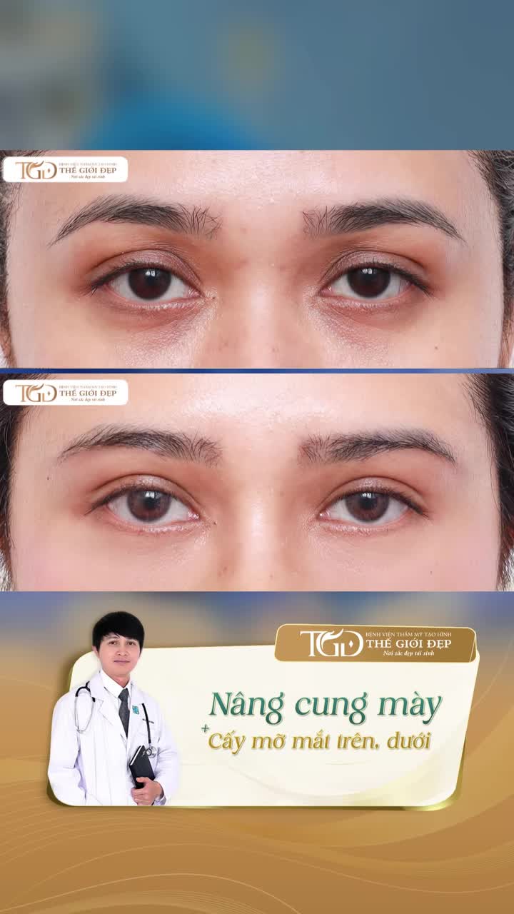 Khi ánh nhìn biết nói - bí quyết hồi sinh nét tươi trẻ cho đôi mắt sau combo nâng cung mày kết hợp cấy mỡ mí mắt trên+dưới.