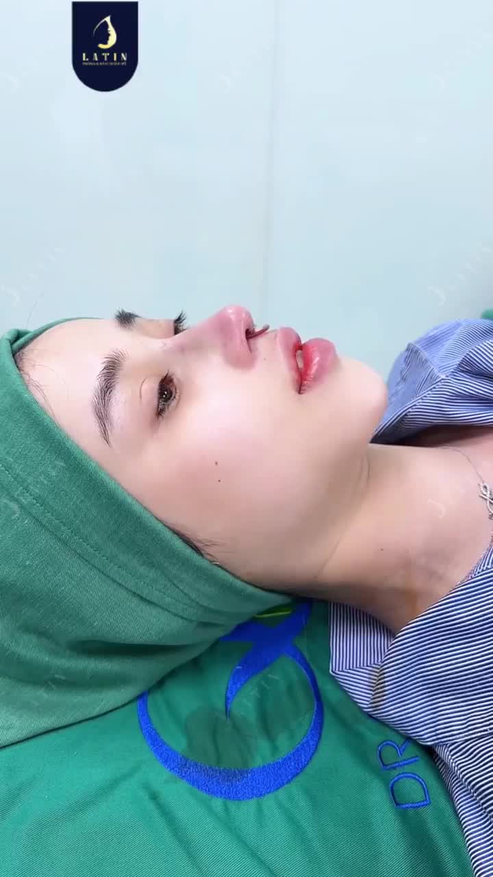 XỬ LÝ FILLER CŨ – ĐỊNH HÌNH SỐNG M.ŨI CAO VỚI SỤN SURGIFORM