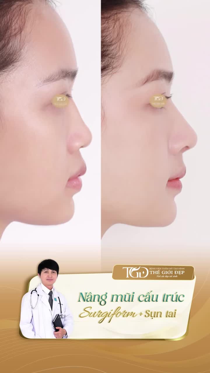 Nâng mũi cấu trúc s.ụn s.ườn - giải pháp cho sống mũi gồ, lõm bẩm sinh, kém liền mạch