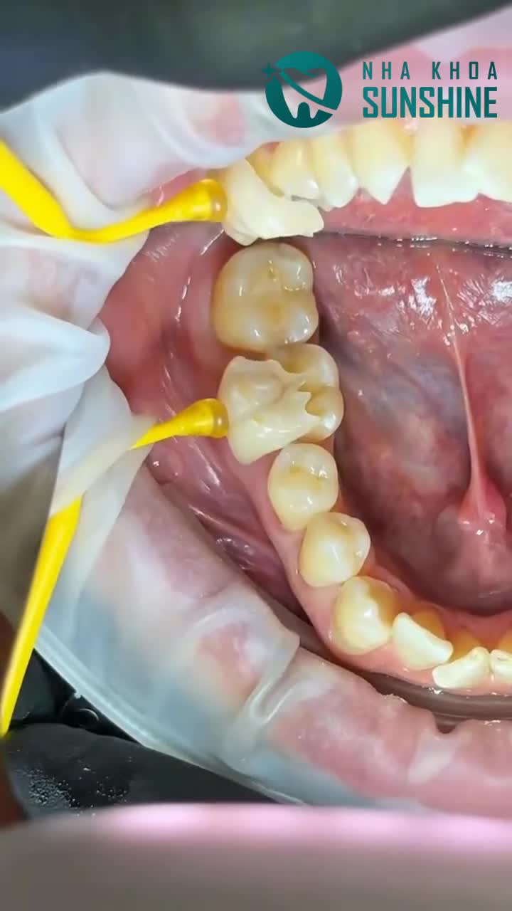 "BẠN ĐÃ BIẾT ĐẾN CÔNG NGHỆ ONLAY SỨ — 'VŨ KHÍ' BẢO VỆ RĂNG SÂU VỠ TỐI ƯU?"