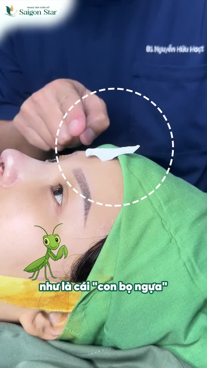 BÁC SĨ HOẠT LOẠI BỎ CHIẾC SỤN "BỌ NGỰA" KHIẾN DÁNG MŨI LỆCH VẸO