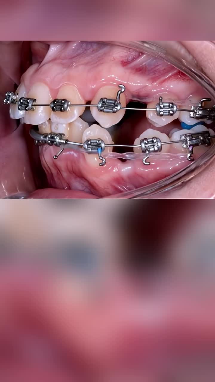 Niềng răng vẫn là chân ái