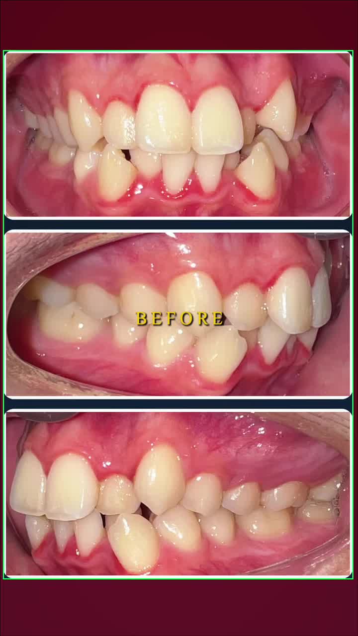 Các bạn đừng quên nha khoa Thế Hệ Mới đang có rất nhiều ưu đãi cho phái nữ ở tháng 10 này, khi niềng răng với mắc cài cũng như niềng trong suốt nhé