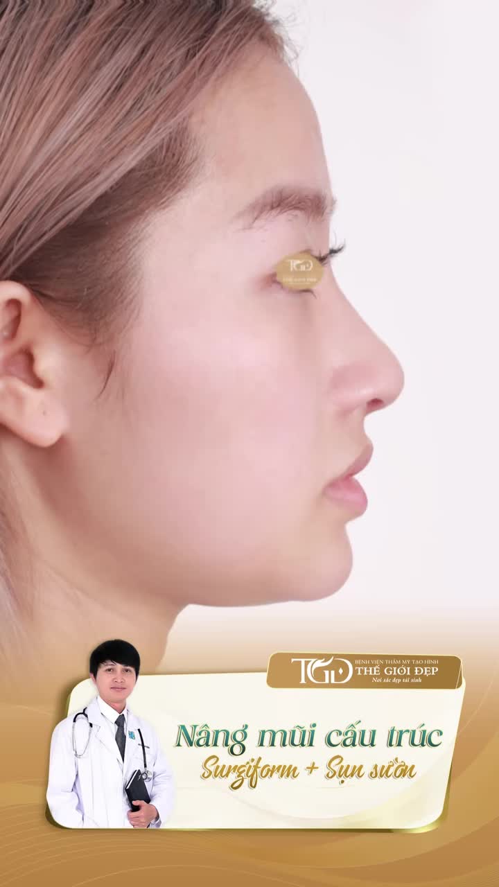 Từ ĐẦU MŨI CỤP đến DÁNG MŨI BAY thanh thoát - Bác sĩ đã thay đổi những gì?