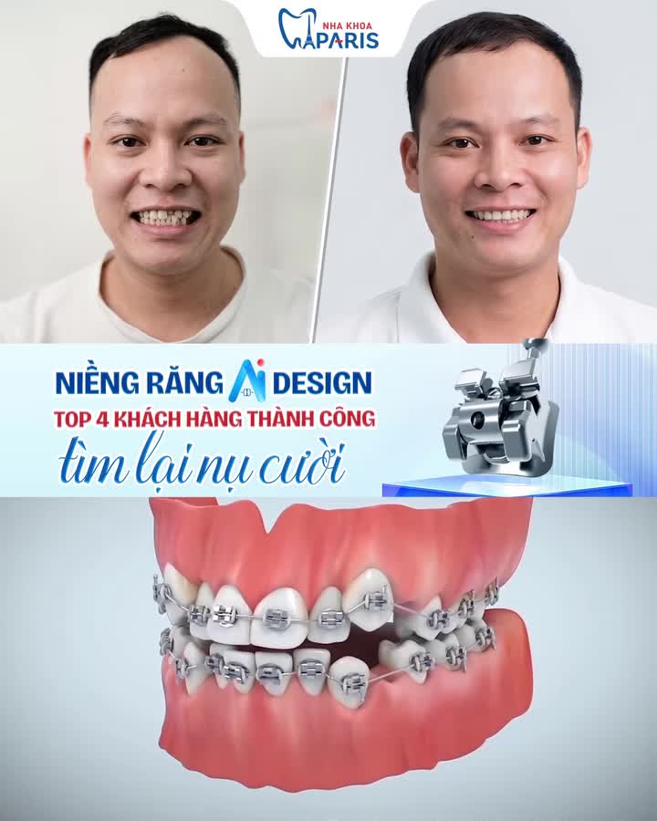 NIỀNG RĂNG AI DESIGN: NHANH HƠN – ÊM HƠN – CHUẨN TỶ LỆ VÀNG!