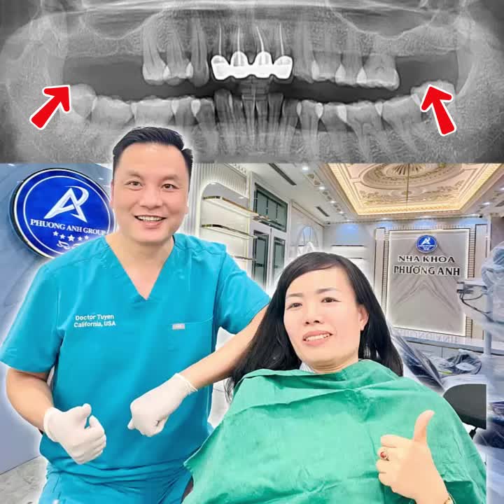 Implant có bền suốt đời không, có phải thay sau vài năm không?