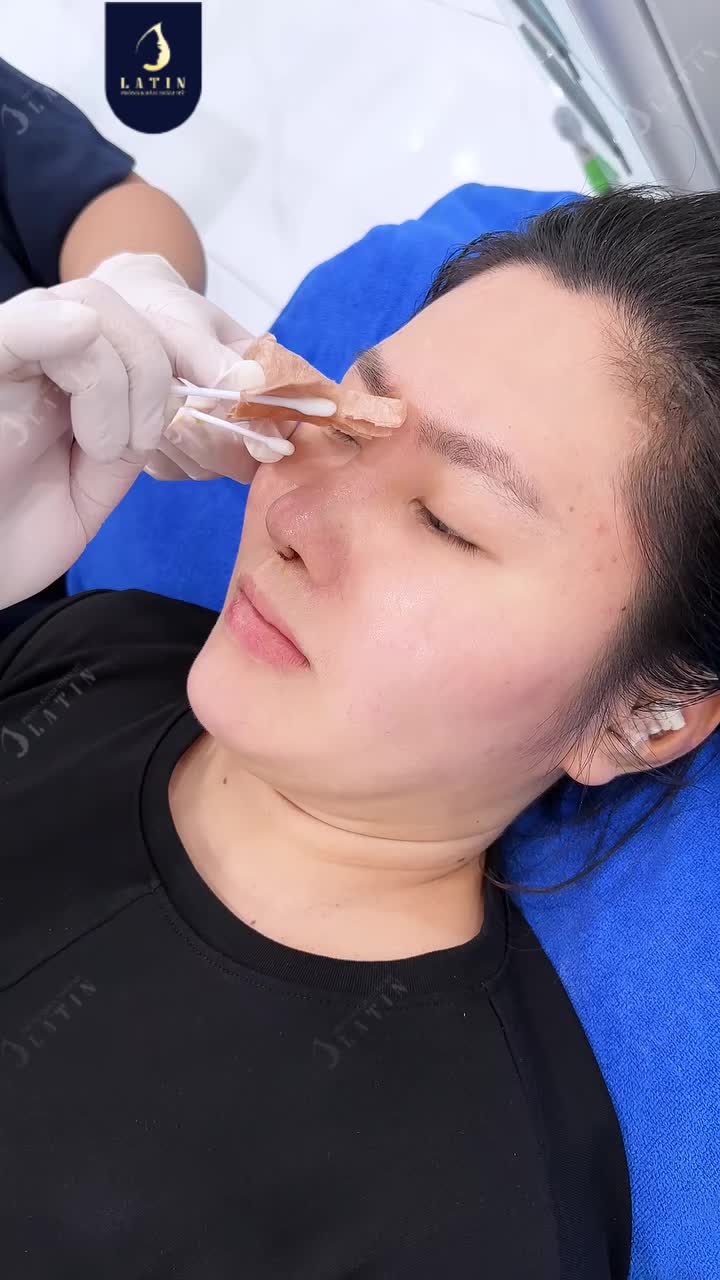 LÊN DÁNG MŨI CẤU TRÚC SURGIFORM CHUẨN NÉT SAU 1 TUẦN "XUẤT XƯỞNG"