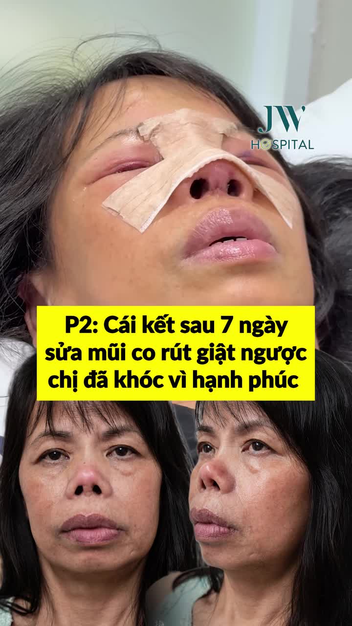 BÁC SĨ TÚ DUNG TÁI SINH MŨI MỚI CHO NỮ VIỆT KIỀU U70 - BẬT KHÓC HẠNH PHÚC SAU 7 NĂM MŨI CO RÚT, HẾCH NGƯỢC