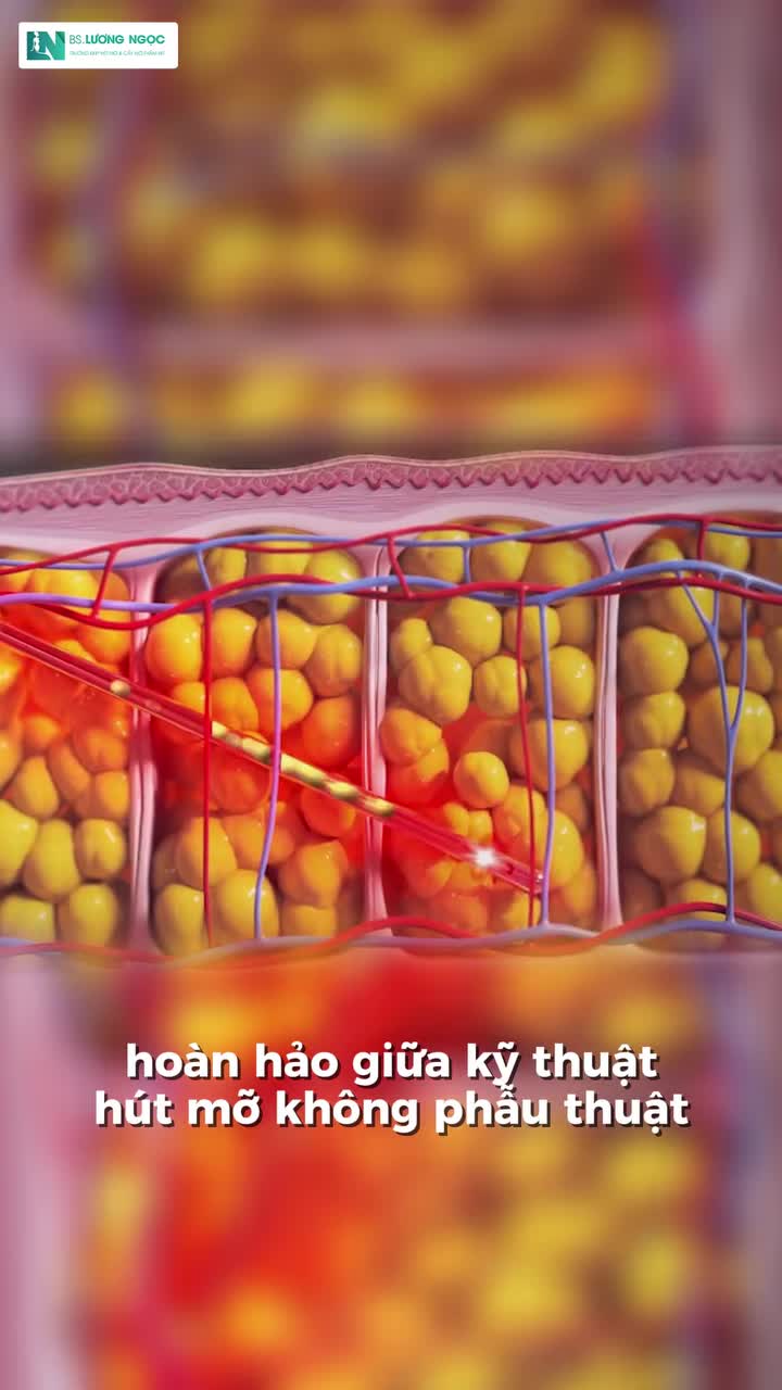 MUỐN EO THON, DÁNG GỌN NHƯNG E NGẠI VIỆC CĂNG CĂ'T DA?