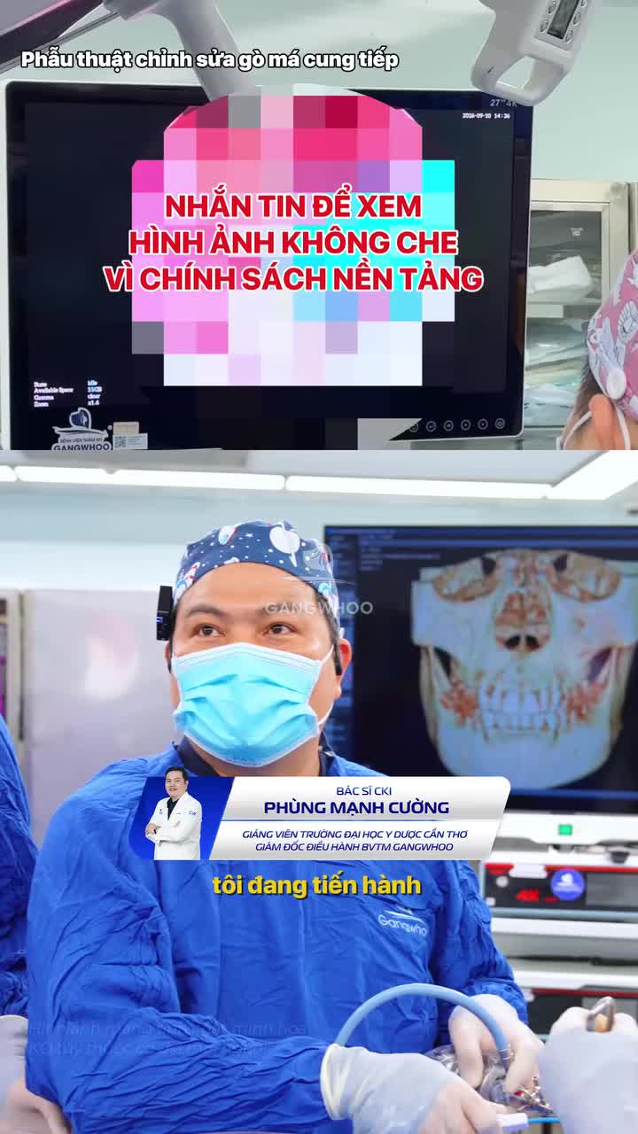 Kỹ thuật bóc tách khách biệt của hạ gò má có sử dụng nội soi 4K tại Bệnh viện thẩm mỹ Gangwhoo