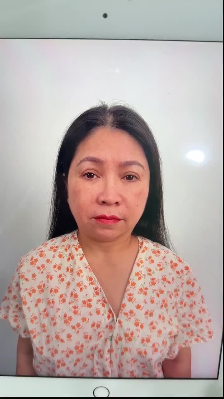 TRẢ KẾT QUẢ NÂNG MŨI + CẮT MÍ MẮT | KH.JENNY NGUYỄN