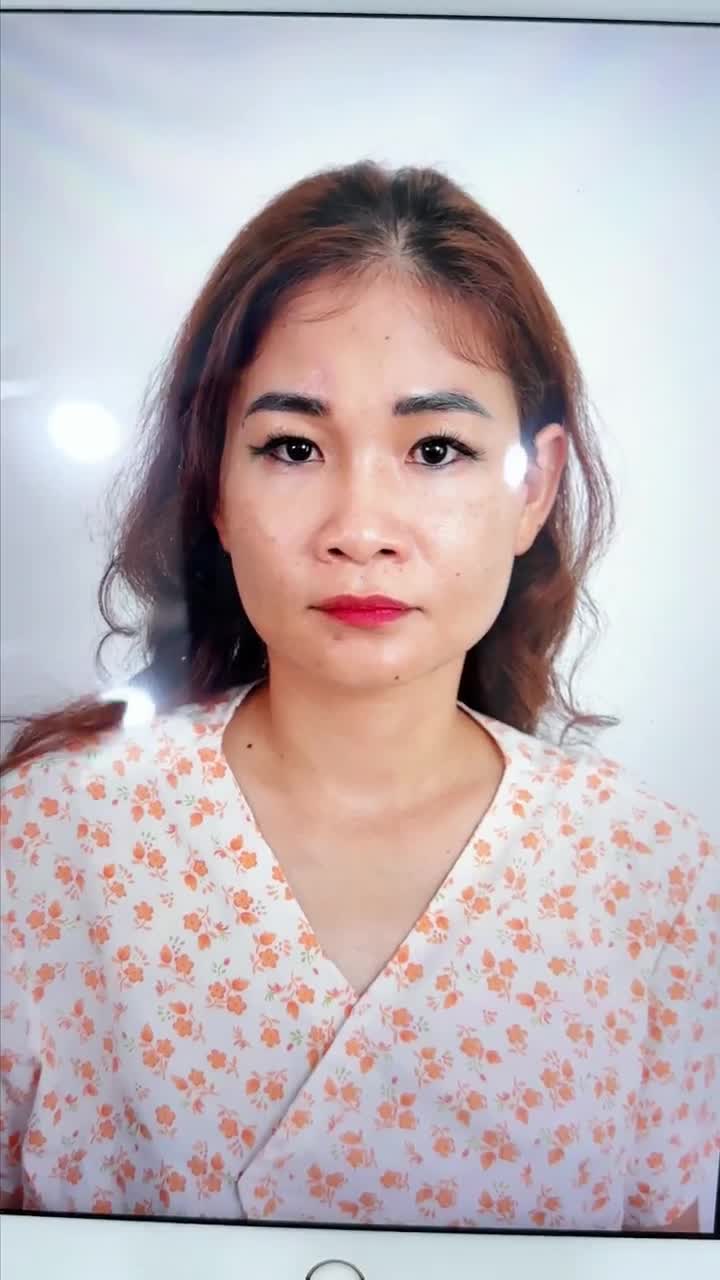 TRẢ KẾT QUẢ NÂNG MŨI NGAY SAU PHẪU THUẬT