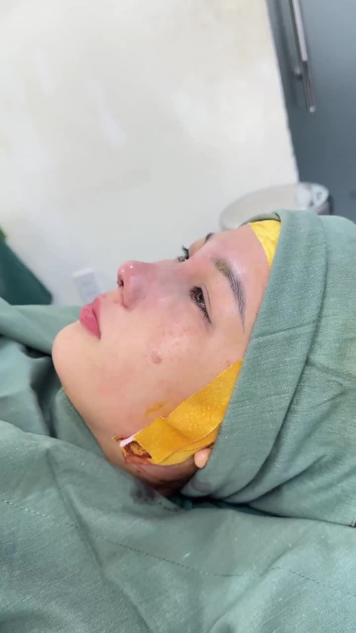 KẾT QUẢ NÂNG MŨI CẤU TRÚC DR. HOẠT - THÀNH CÔNG KIẾN TẠO GÓC NGHIÊNG SAU 60 PHÚT