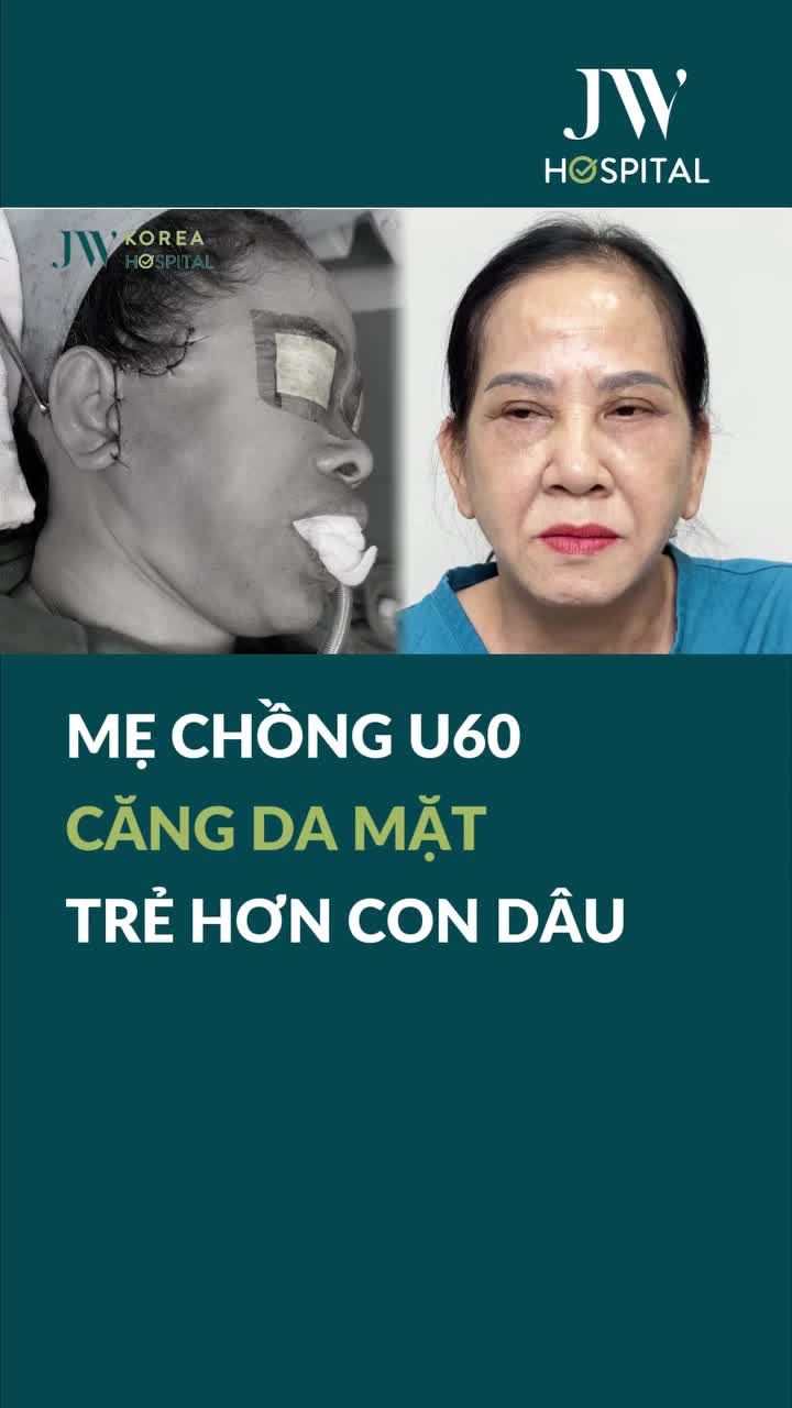 U60 BÌNH DƯƠNG ĐƯỢC CẢ NHÀ HỘ TỐNG ĐẾN JW TRẺ HÓA – CĂNG DA MẶT KẾT HỢP CẤY ΜỠ BABY FACE, TRẺ ĐẸP HƠN CẢ CON DÂU!