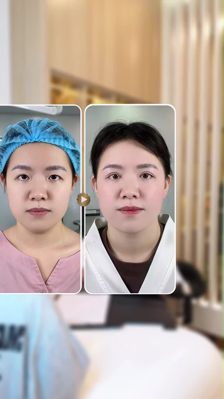 Mở góc ngoài có cải thiện độ xếch của mắt hay không?