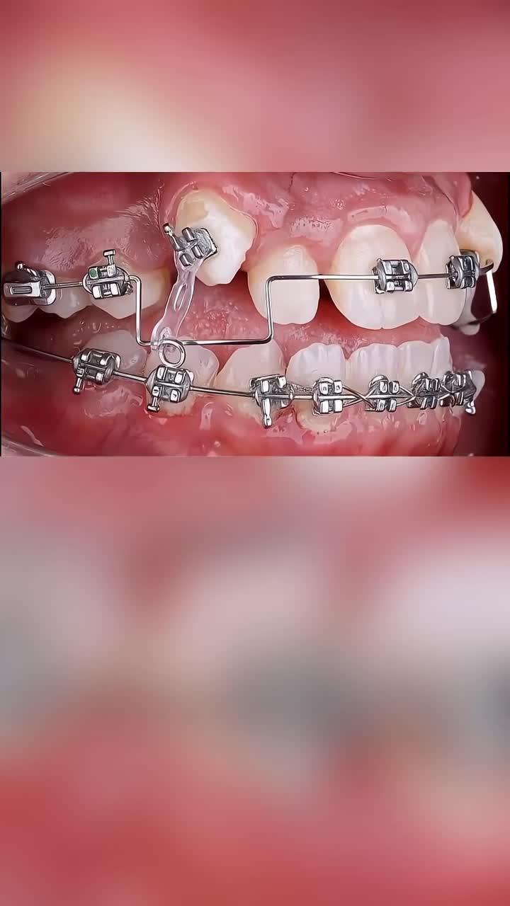 Kiên trì niềng răng là thành công một nửa