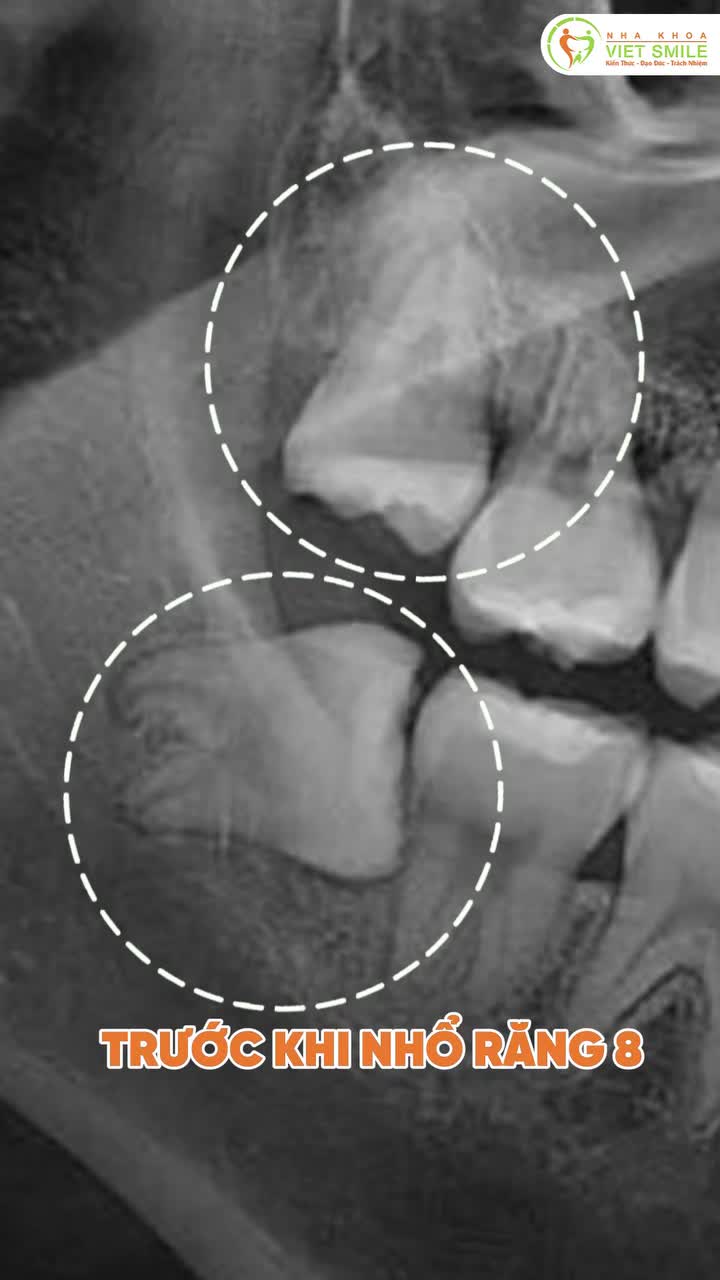15 phút cho một ca nhổ răng khôn nhẹ nhàng.