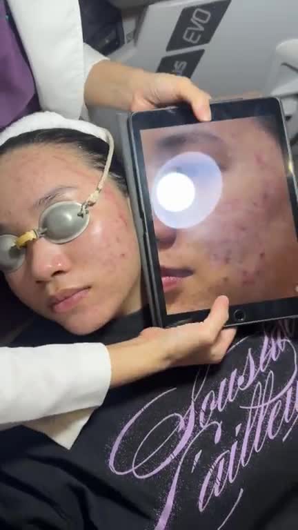 CẬN CẢNH làn da MỊN MÀNG, ĐẸP ΚHÔΝG TÌ VẾT của cô nàng Gen Z sau 2 buổi điềᴜ ᴛʀị mụɴ tại JW