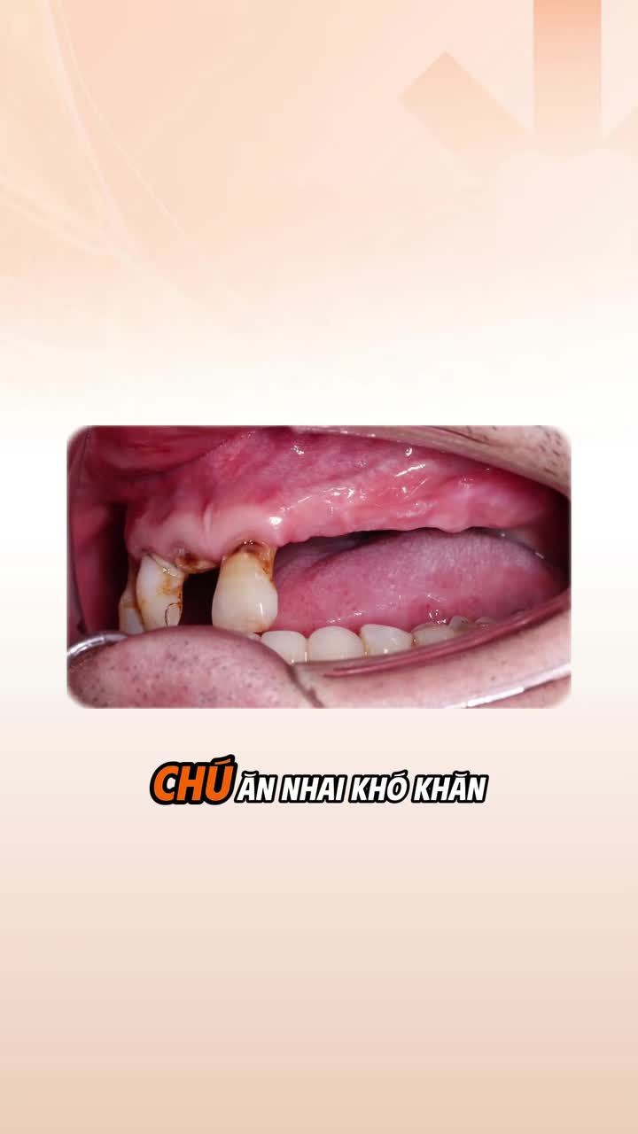 72 tuổi, hàm trên chỉ còn 3 răng khiến chú P nhiều năm gần như chỉ ăn cháo và nuốt chửng thức ăn.