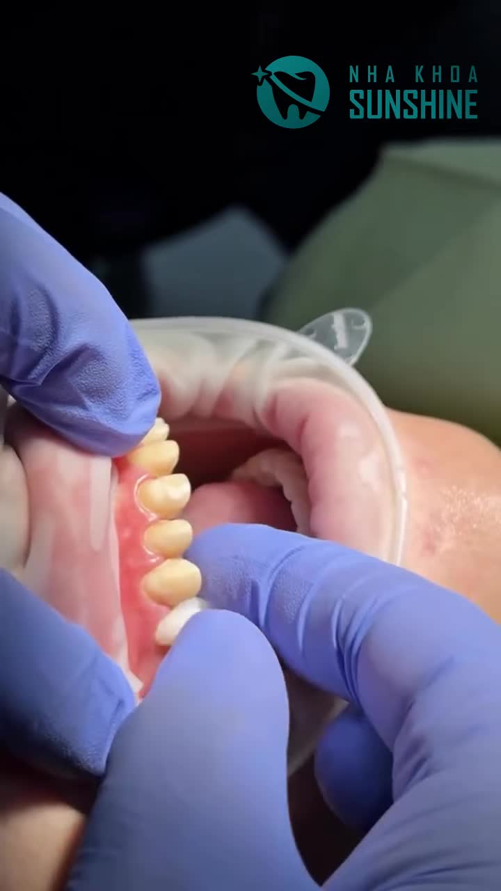 "BỌC RĂNG SỨ HAY DÁN SỨ VENEER: ĐỪNG CHỌN THEO XU HƯỚNG, HÃY CHỌN THEO CHỈ ĐỊNH!"