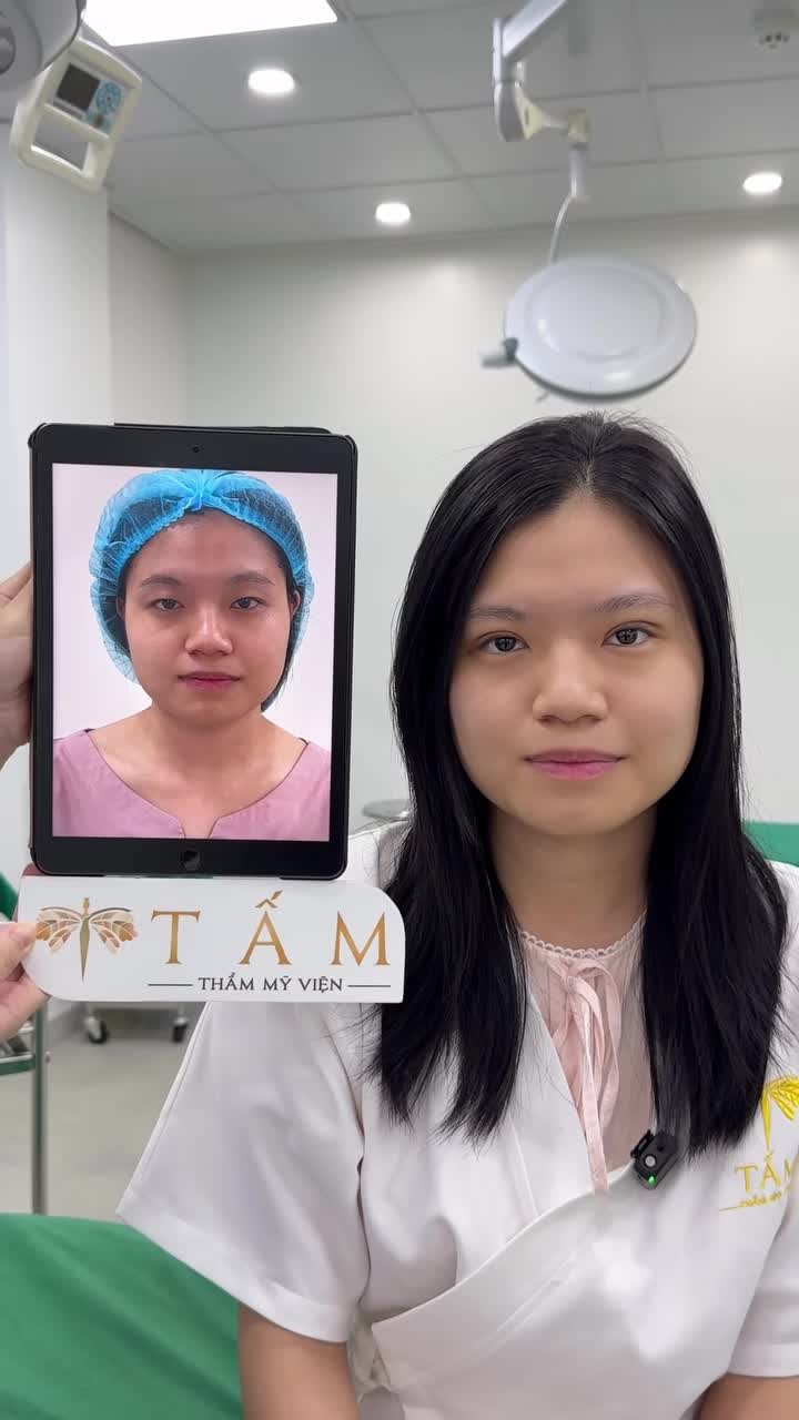 Cùng Tấm ngắm nhìn kết quả ưng ý và nụ cười hài lòng sau cắt mí của bé đẹp N.C