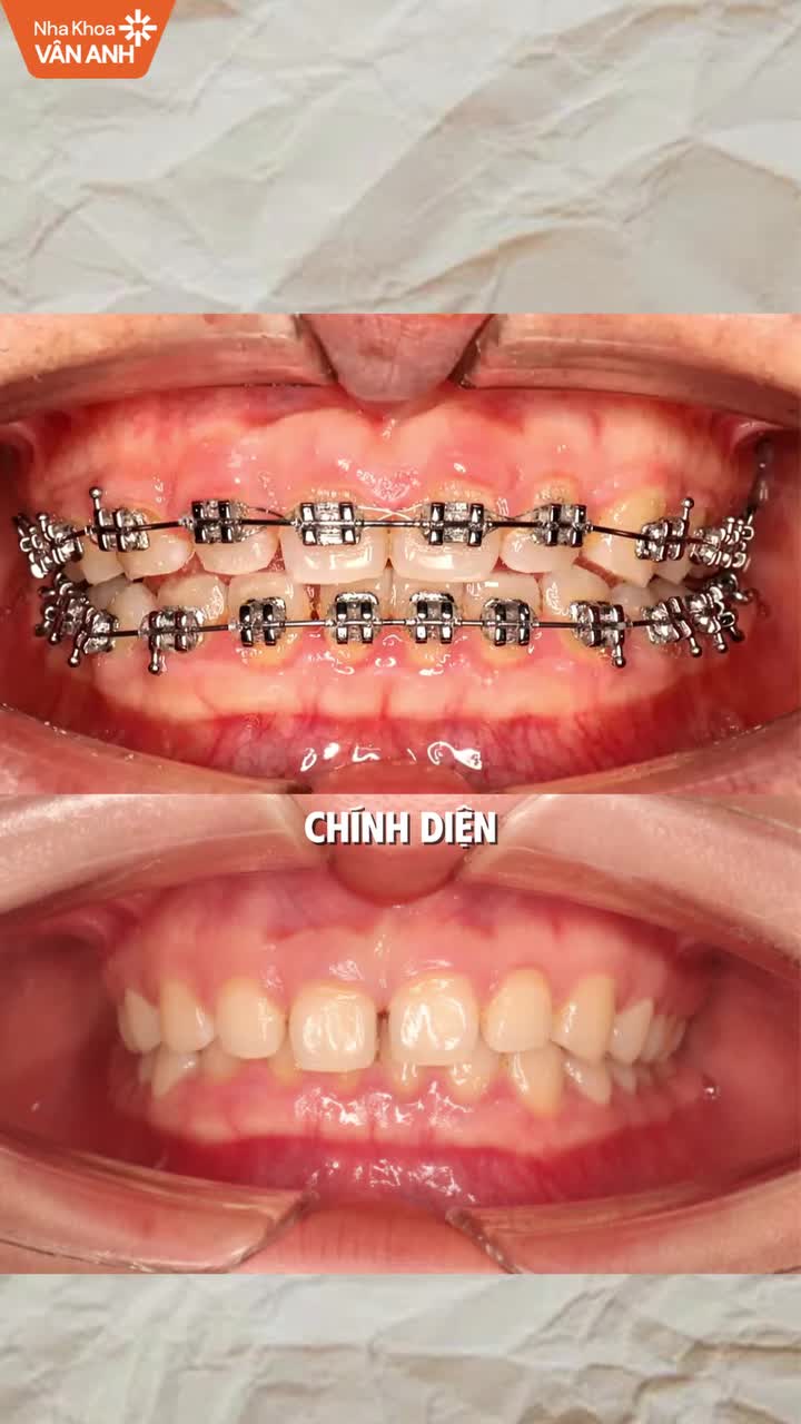 Tình trạng: Răng cửa hàm nhỏ, nhiều khe thưa, trục răng cửa cụp, phanh môi bám thấp và tình trạng cắn trùm sâu