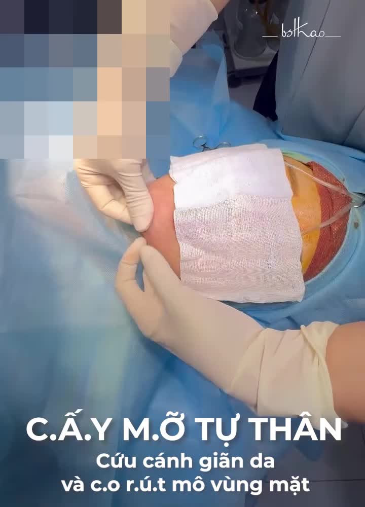 Vùng cằm bị giãn da, co rút sau đặt sụn thì cải thiện như thế nào?