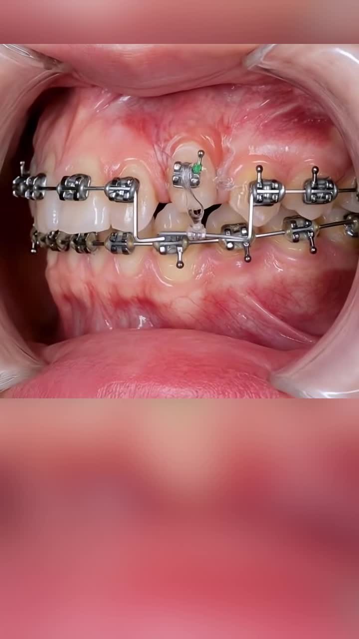 Răng trốn trong xương gặp mắc cài vẫn “ngoan” như thường