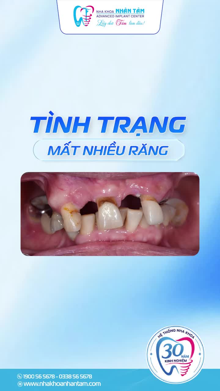 Một ca implant tốt không chỉ nằm ở kết quả cuối cùng, mà còn ở cách bác sĩ chuẩn bị cho từng bước.