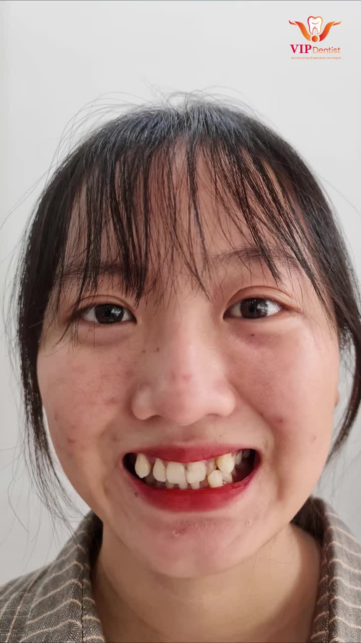KHÔNG NHỔ RĂNG CÓ NIỀNG ĐƯỢC KHÔNG?
