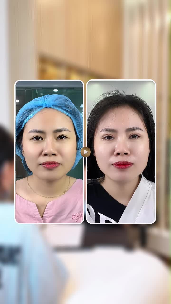Nhấn mí xong tháo ra thì mắt có về lại form ban đầu không?