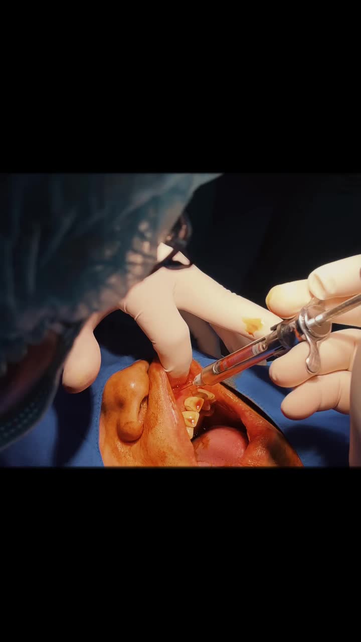Implant case răng cửa "lối vào lắc léo" Đơn giản hơn với sự hỗ trợ của máy Dcarer