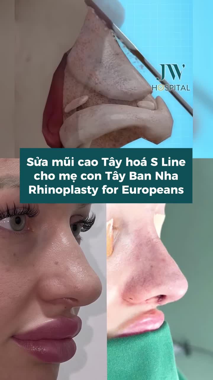 HAI MẸ CON TỪ CHÂU ÂU DẮT TAY ĐẾN VIỆT NAM SỬA MŨI CAO TÂY THÀNH S LINE THANH TÚ