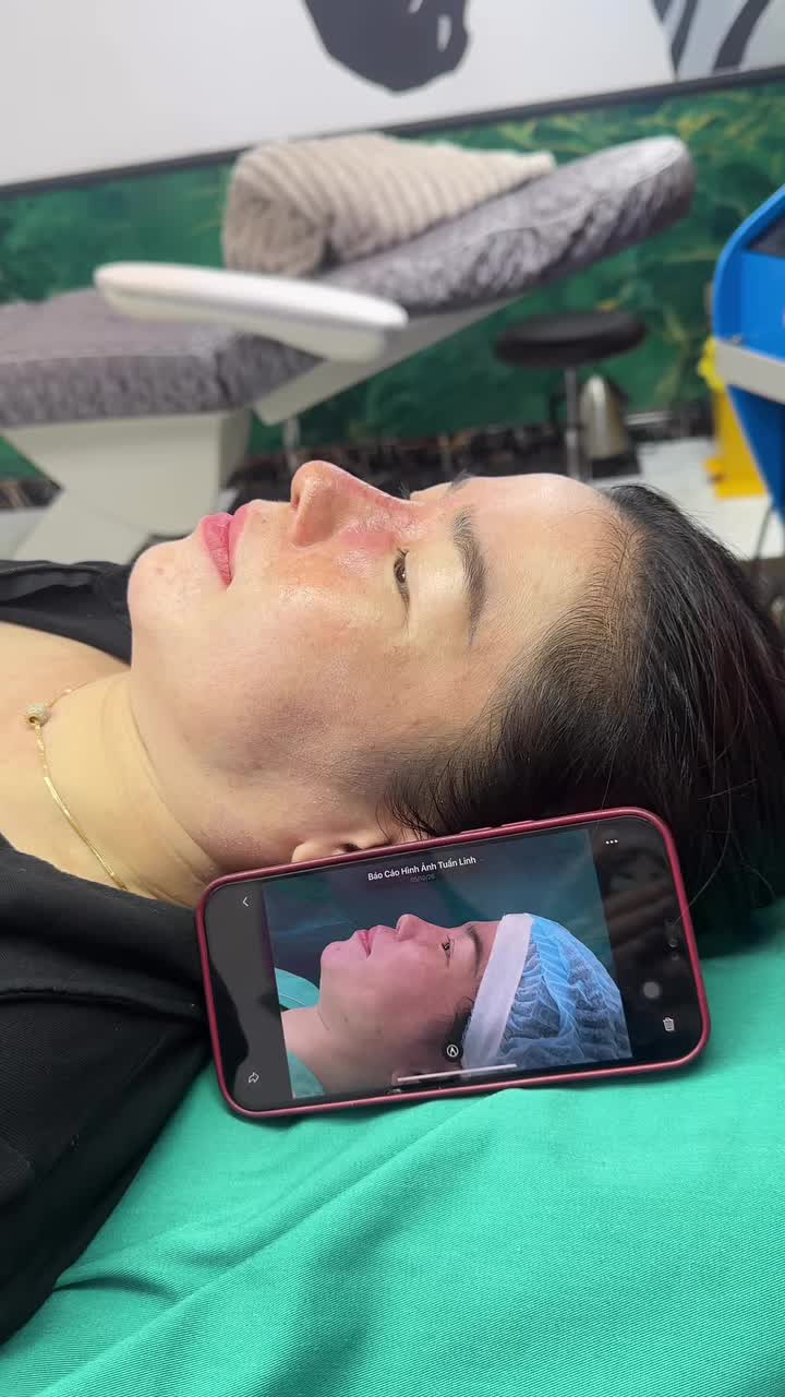 Mũi cấu trúc sửa lại sau 12 ngày
