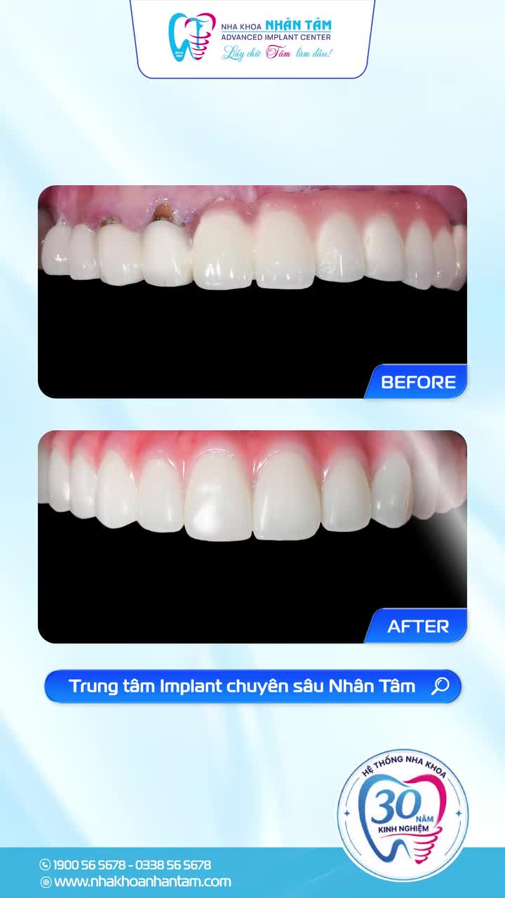 MẤT RĂNG RỒI, TẠI SAO NÊN LÀM LẠI SỚM?