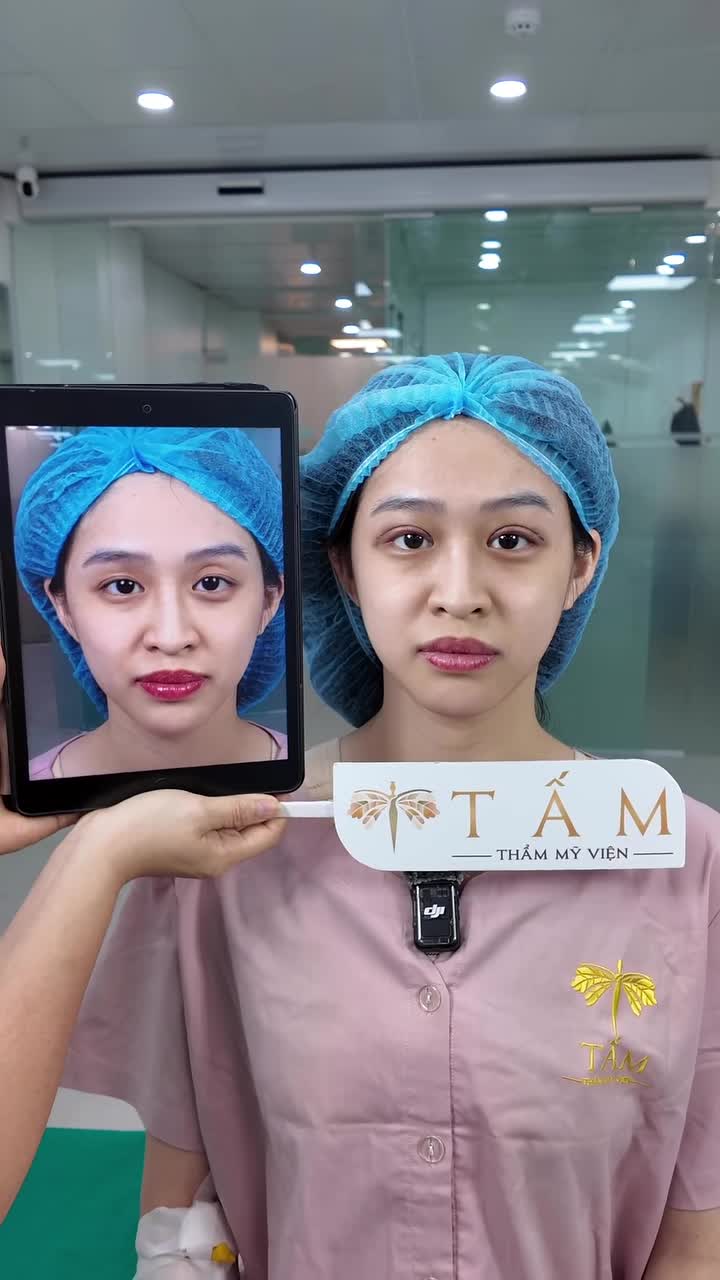 Kết quả sau khi cắt mí cấy mỡ tại Tấm sẽ như thế nào?
