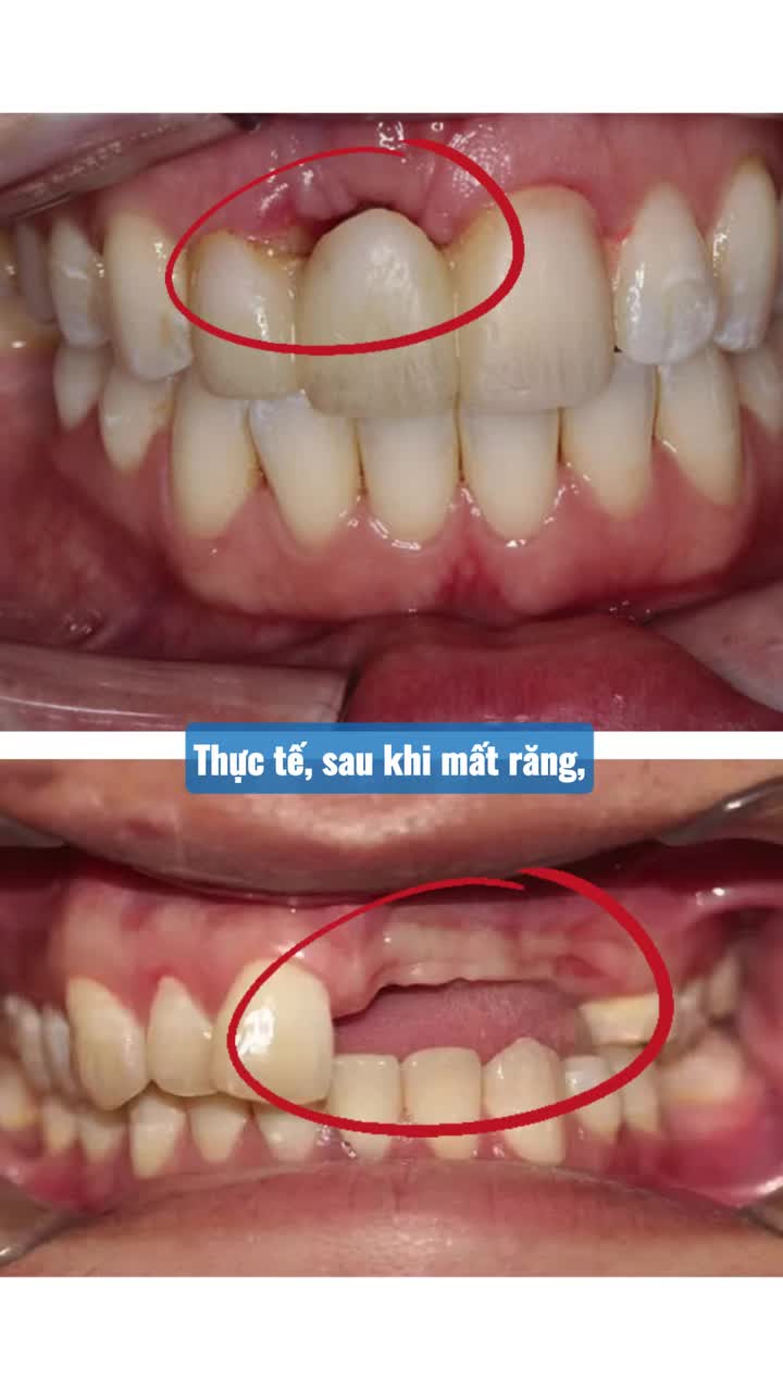KHI NÀO NÊN TRỒNG RĂNG IMPLANT?